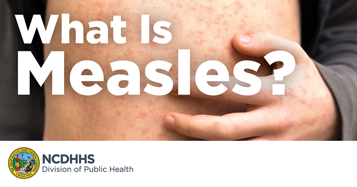 Up close image of a measles rash with the words “What is Measles?” on top of the image.